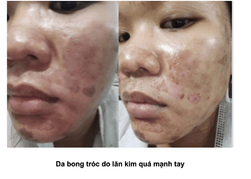 Lăn kim tại nhà - cơn sốt làm đẹp dễ dàng hay rủi ro khôn lường cho da?