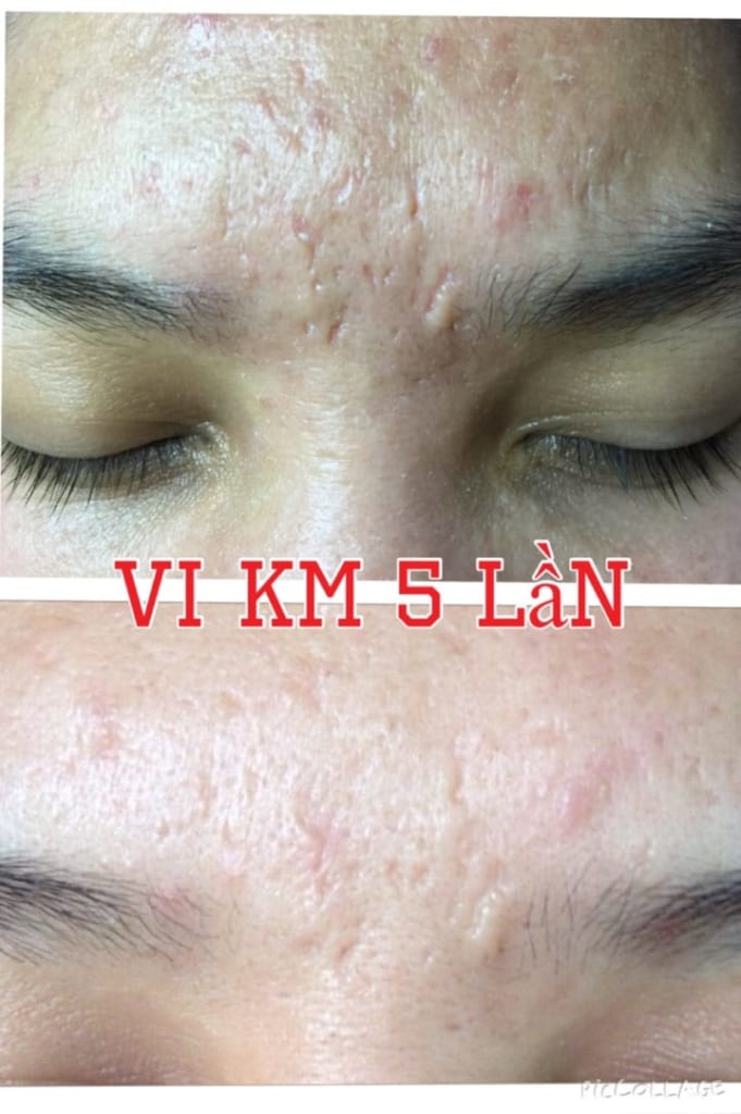 Hiệu quả vi kim sinh học