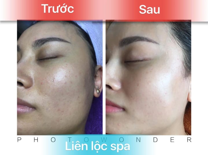 Hiệu quả vi kim sinh học