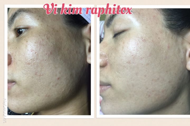 Raphitox hiệu quả