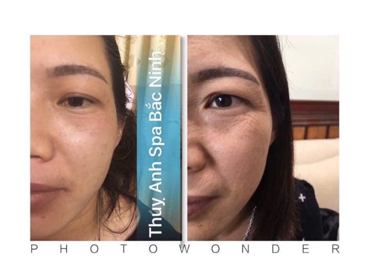 Raphitox hiệu quả