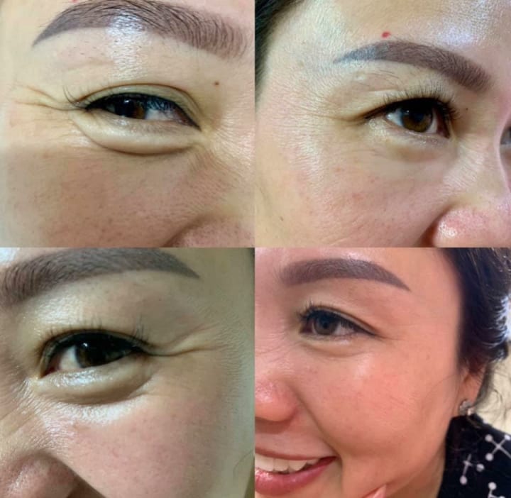 Khách hàng cải thiện đôi mắt thành công nhờ kem mắt vi kim sinh học Idenel.