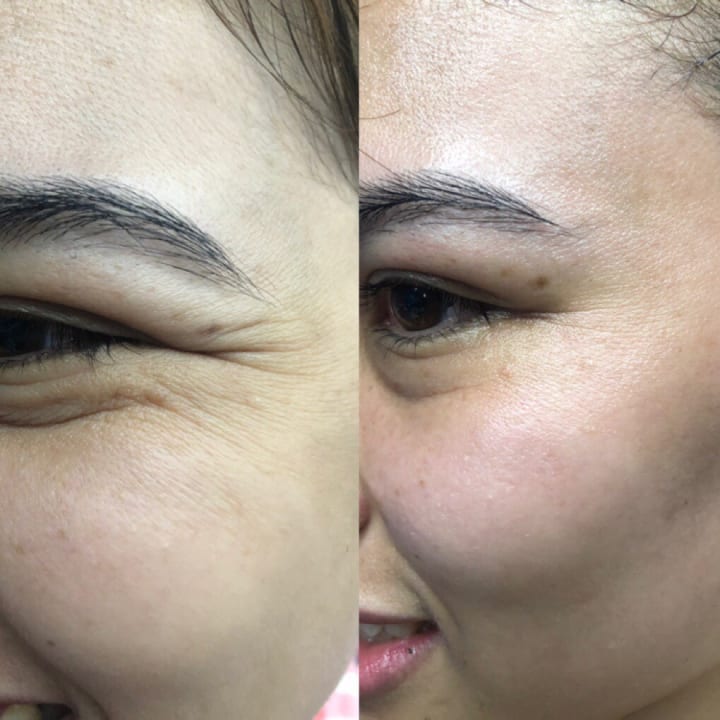Kem mắt vi kim hiệu quả