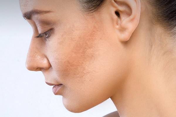 Hãy cẩn thận với việc rối loạn nội tiết tố nếu thấy da xỉn màu.