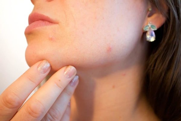 Rối loạn nội tiết tố là một trong những nguyên nhân gây mụn ẩn.