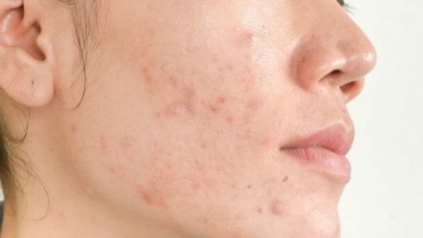 Mụn ẩn thường xuất hiện ở cằm, má và trán.