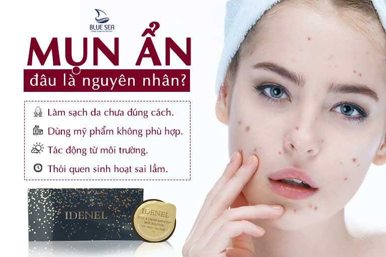 Đây là những nguyên nhân chính gây ra mụn ẩn.