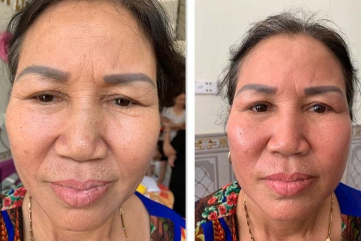 Vi kim sinh học Raphitox giúp trẻ hóa làn da cho mọi đối tượng, ở mọi độ tuổi.