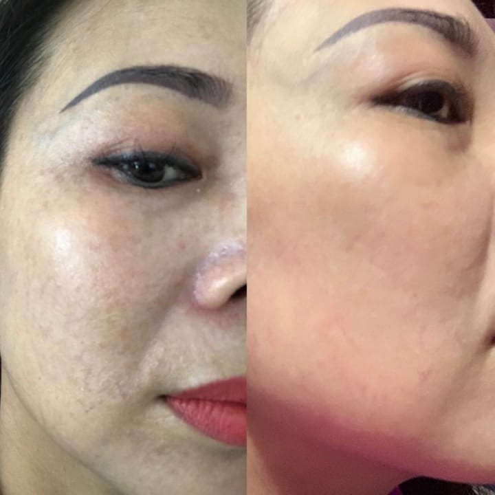 Da giãn mao mạch hồi phục thành công nhờ vi kim sinh học Raphitox.