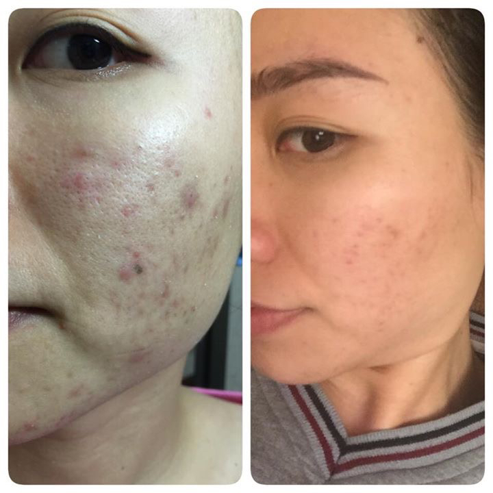 Raphitox giúp trị mụn hiệu quả.