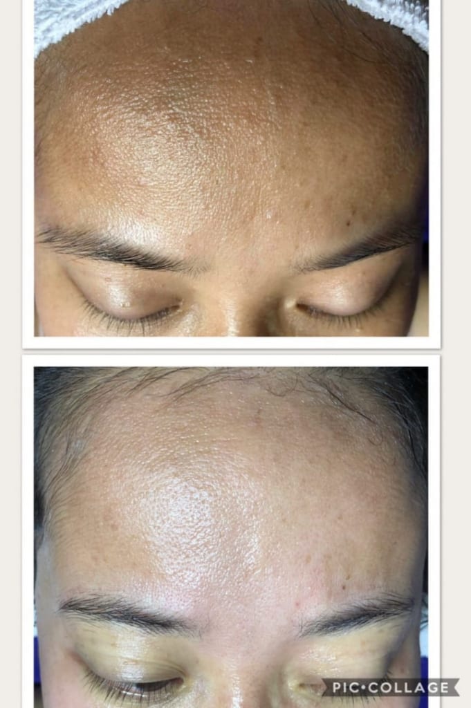 Cận cảnh làn da sần bì trở nên mịn màng hơn sau khi dùng vi kim sinh học Raphitox.