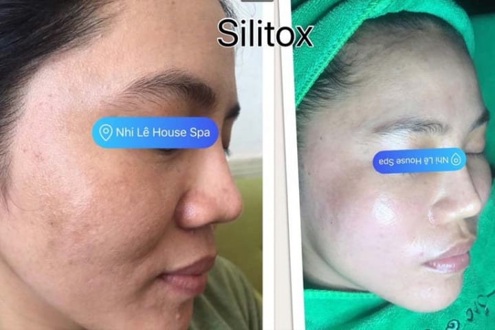 Làn da trắng sáng rõ rệt sau liệu trình vi kim Raphitox.