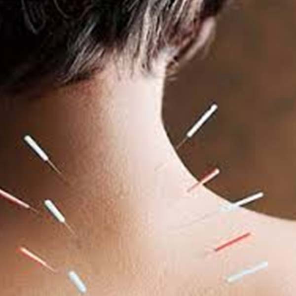 Sử dụng phương pháp châm cứu
