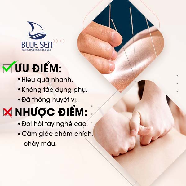 Ưu - nhược điểm của phương pháp châm cứu bấm huyệt.
